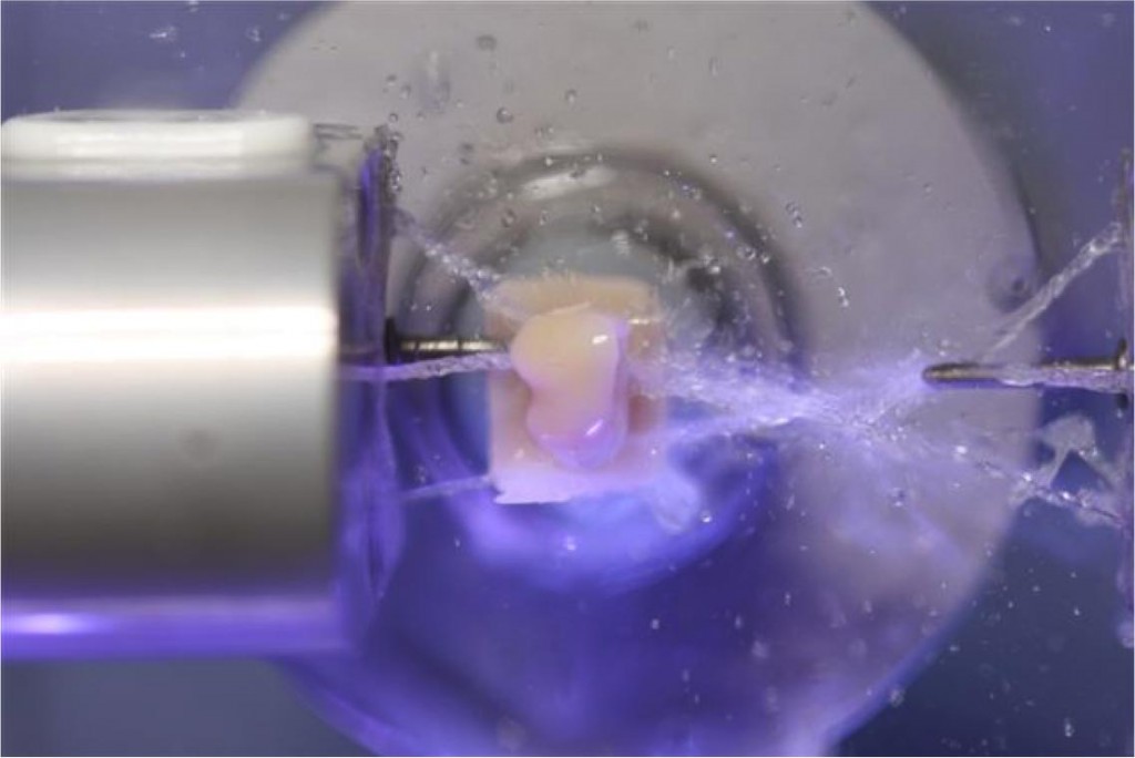 CEREC, une méthode de restauration assistée par ordinateur Rive Sud