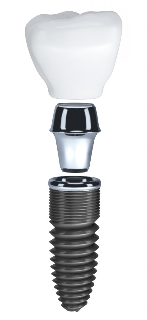 Implant-dentaire chez concept dentaire Rive Sud