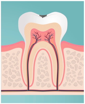 Caries to be treated