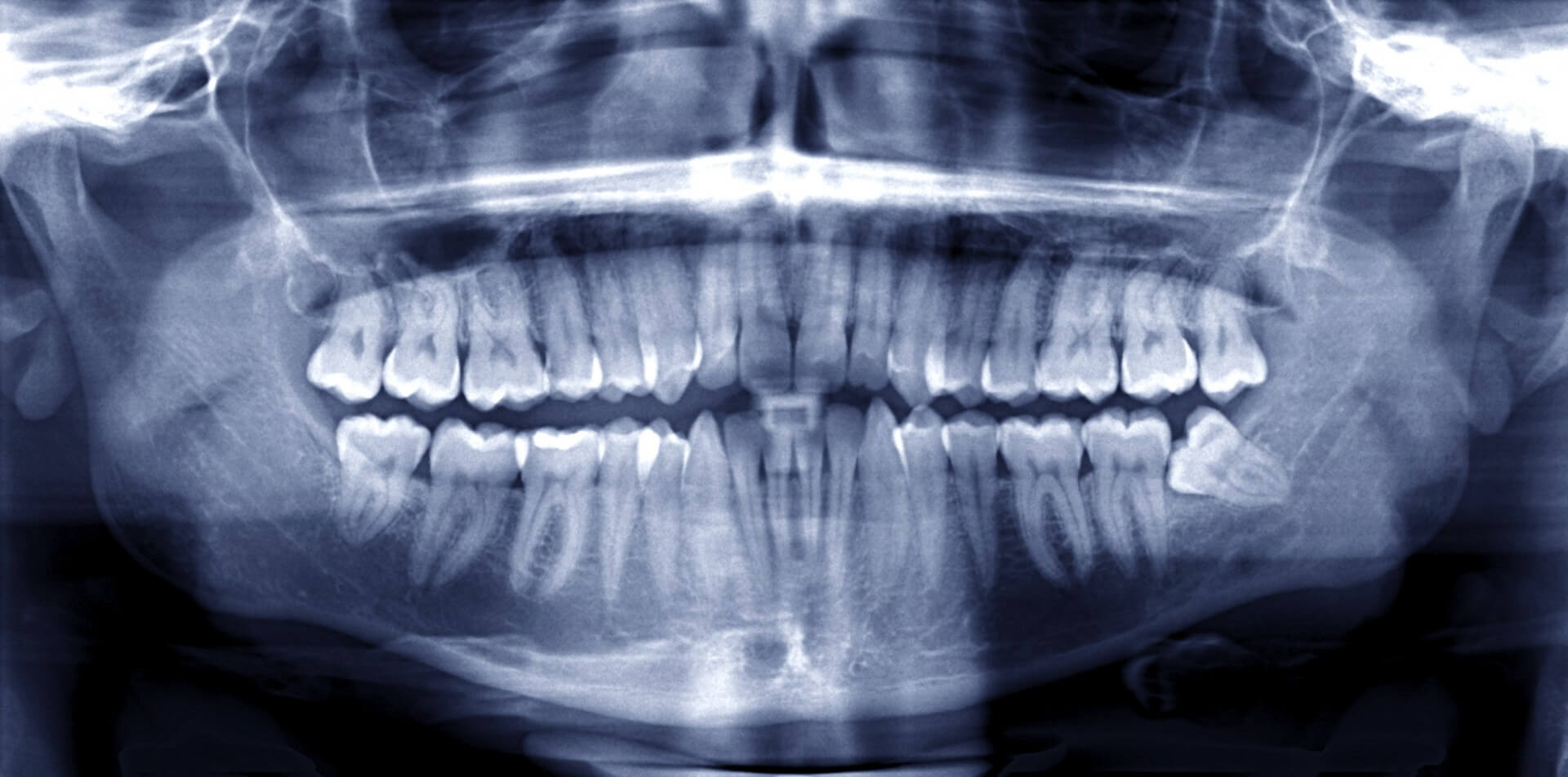 Radiographie préventive