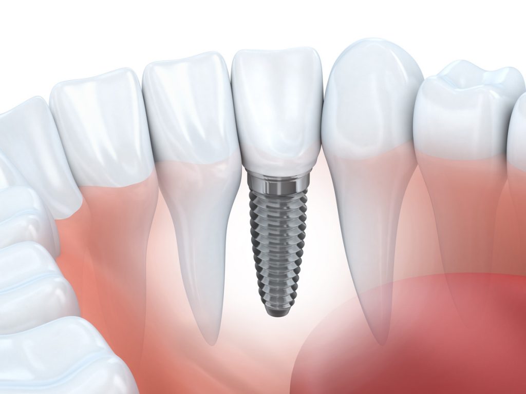 La procédure de pose d’implant(s) dentaire(s)