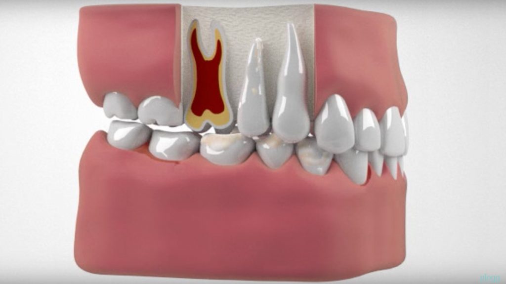 La parodontite concept dentaire Rive Sud