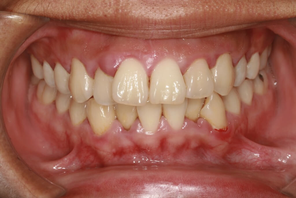 La gingivite concept dentaire Rive Sud