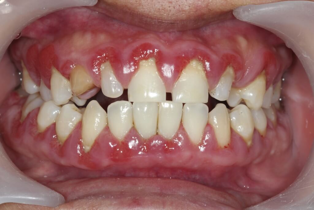 Éviter que la gingivite se transforme en parodontite