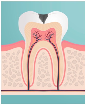 Severe caries and dental infections